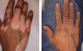 ترمیم ویتیلیگو پیسی برص